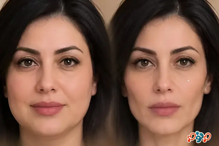 صورت اوزمپیکی